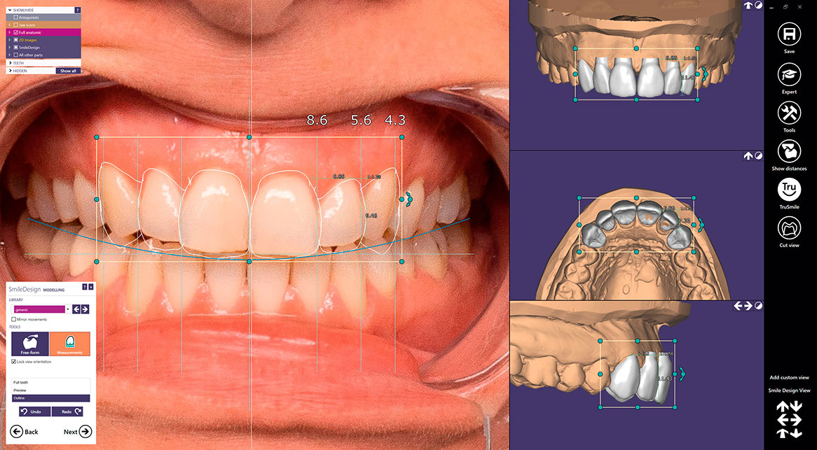 Diseño CAD dental Exocad