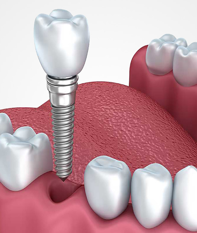 Prótesis sobre implantes